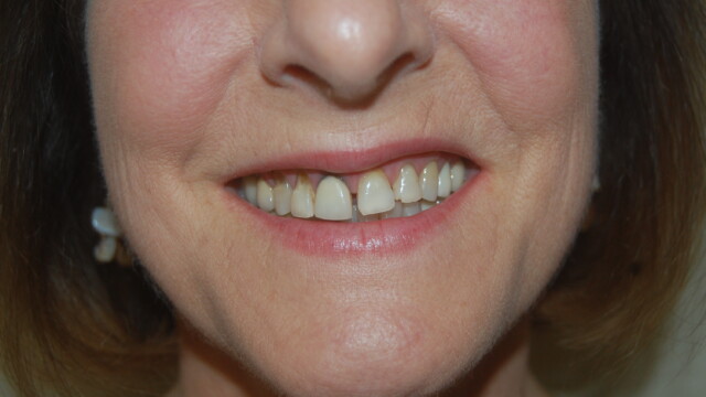 Before Smile restoration before treatment by Reichel Dental in Erie, PA