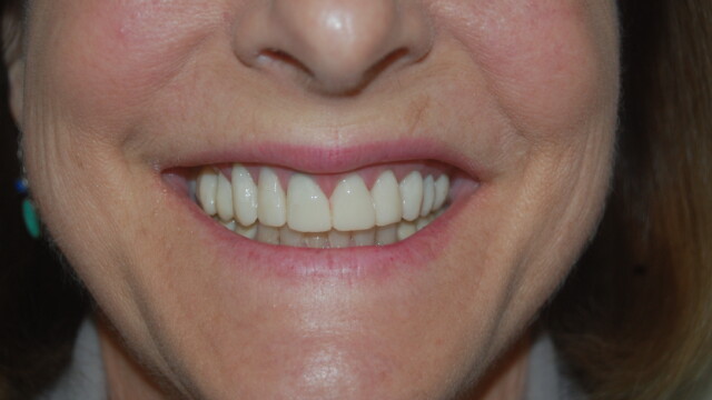 After Smile restoration after treatment by Reichel Dental in Erie, PA