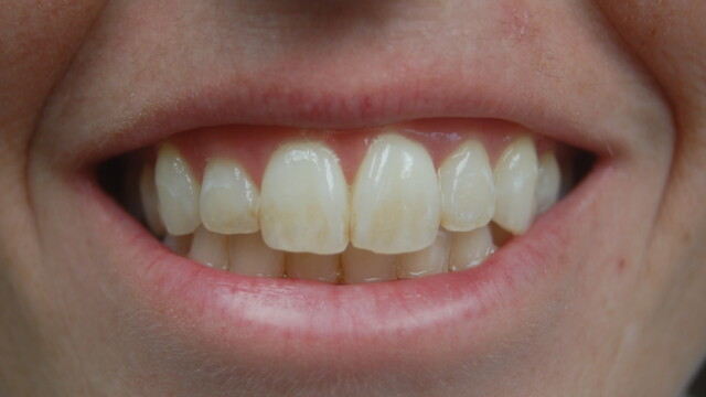 Before Before Teeth whitening treatment by Reichel Dental in Erie, PA