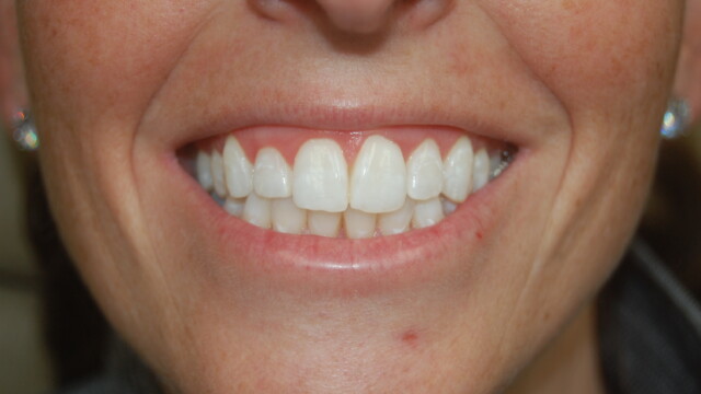 After Teeth whitening after by Reichel Dental in Erie, PA
