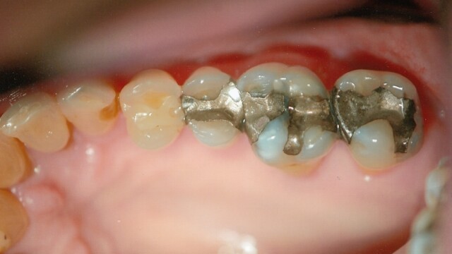 Before Before photo of a successful cosmetic dentistry procedure