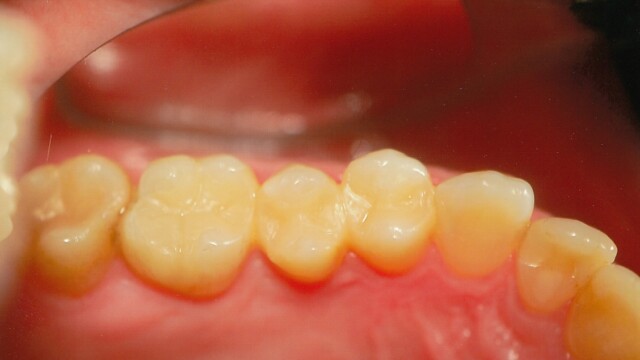 After After photo of a successful cosmetic dentistry procedure