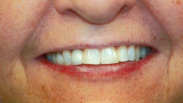 Before Before Veneers by Reichel Dental in Erie, PA