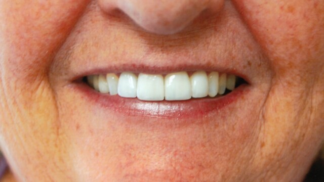 After Veneers by Reichel Dental in Erie, PA