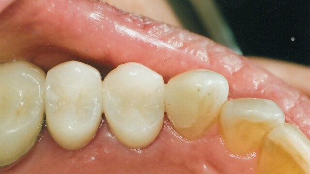 After Before photo of a successful cosmetic dentistry procedure