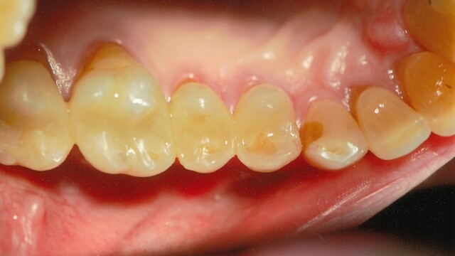 After photo of a successful cosmetic dentistry procedure