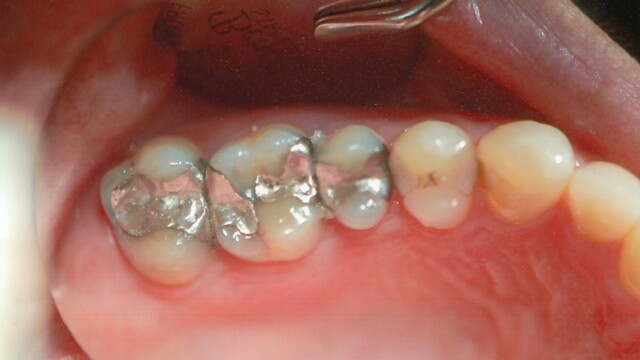 Before Before photo of a successful cosmetic dentistry procedure
