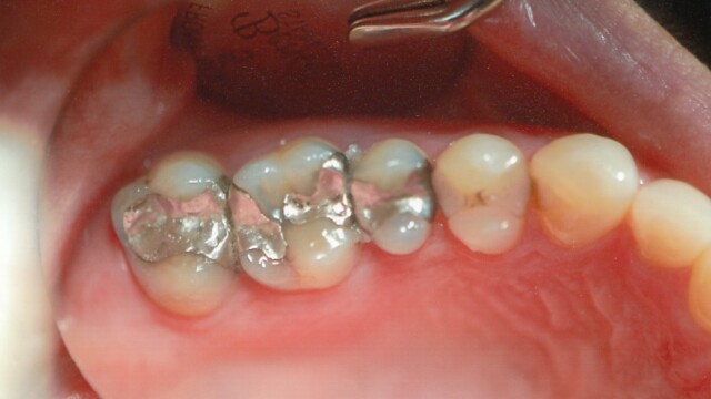 Before Before photo of a successful cosmetic dentistry procedure