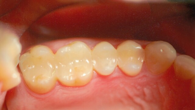 After After photo of a successful cosmetic dentistry procedure