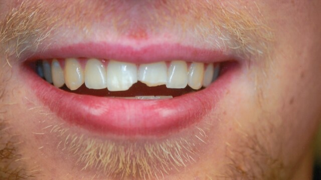 Before Before photo of a successful cosmetic dentistry procedure