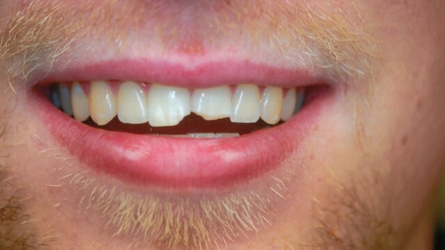 Before Before photo of a successful cosmetic dentistry procedure
