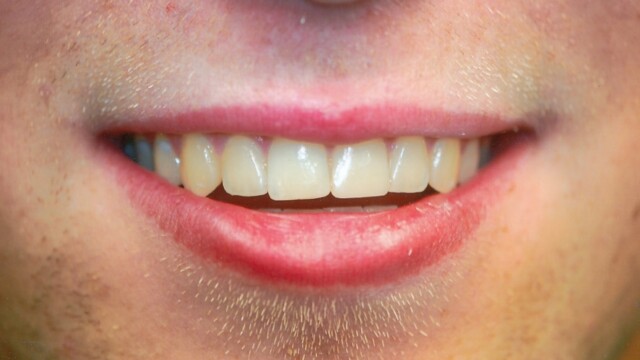 After After photo of a successful cosmetic dentistry procedure