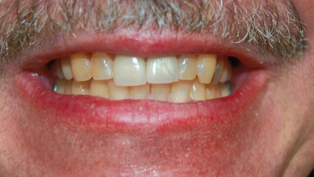 Before After photo of a successful cosmetic dentistry procedure