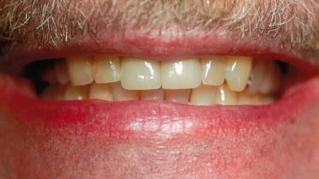 After Before photo of a successful cosmetic dentistry procedure