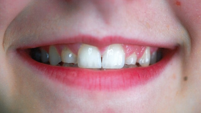 Before After photo of a successful cosmetic dentistry procedure