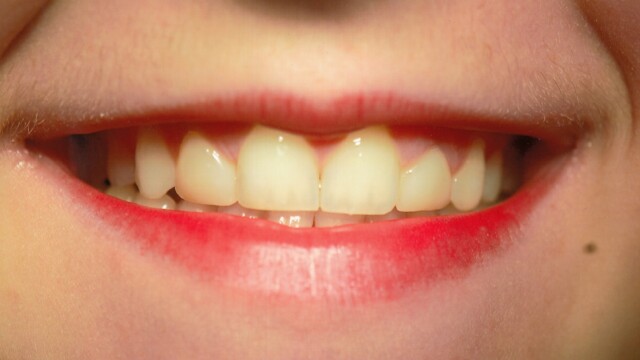 After Before photo of a successful cosmetic dentistry procedure